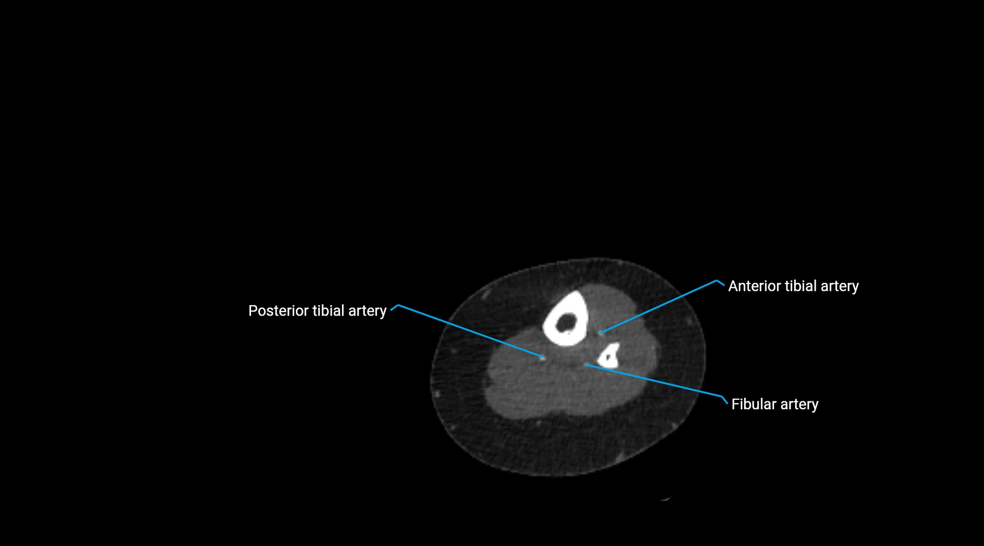 CTA lower limb cross sectional anatomy labelled image _225.webp